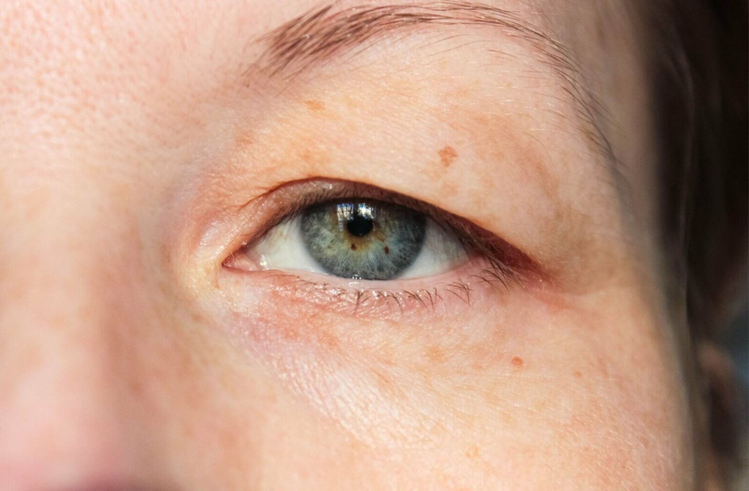 Oculoplasty eye procedure