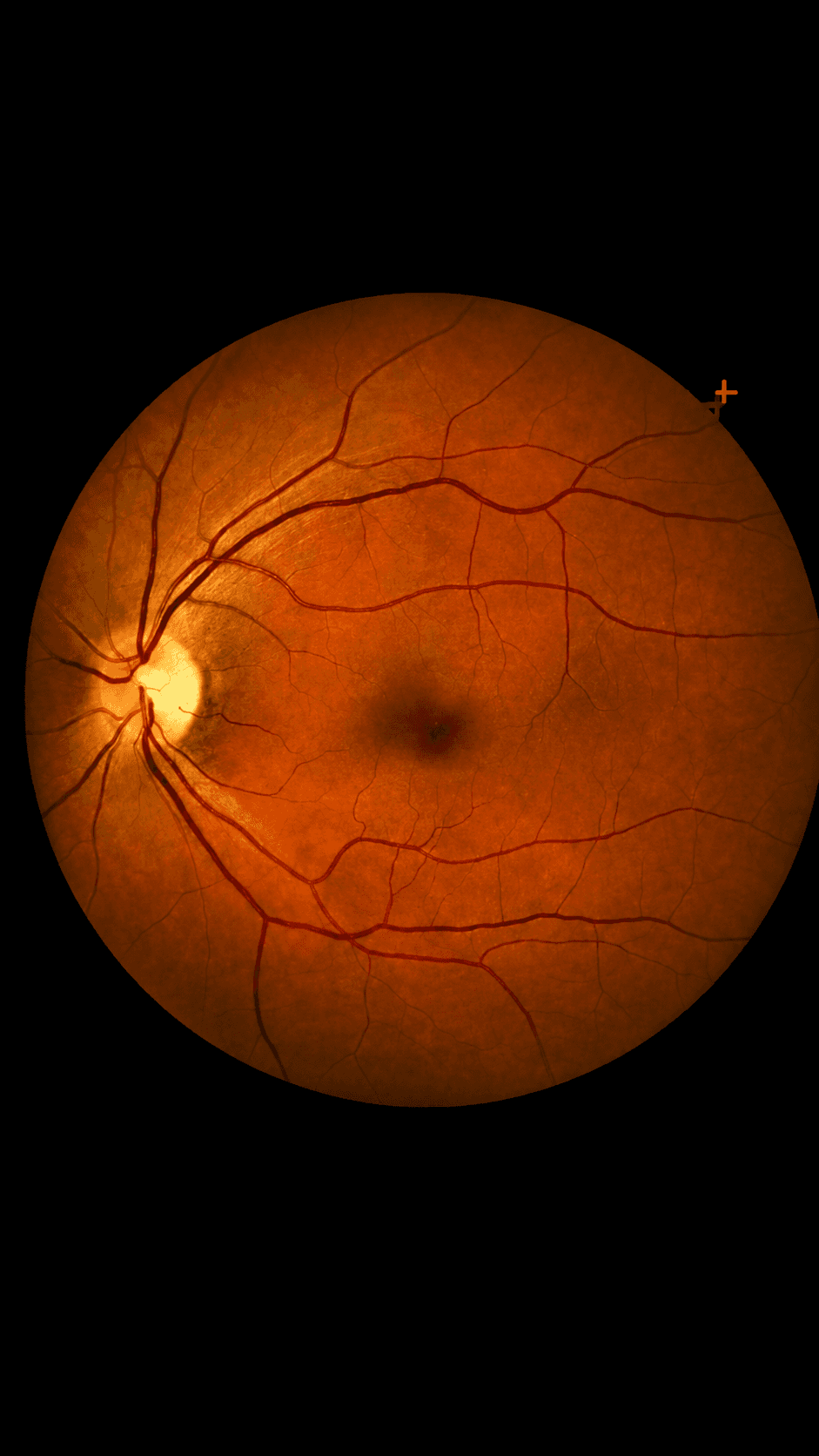 Retina & Vitreous